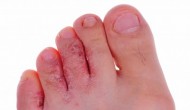 Foot Cellulitis Foot Cellulitis
