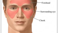 Nasal Cellulitis Nasal Cellulitis