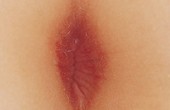 Perianal Cellulitis Perianal Cellulitis