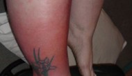 What is Cellulitis? What is Cellulitis?
