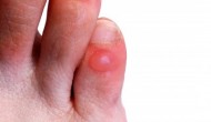 Blisters