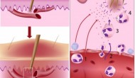 Skin Inflammation
