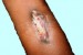 Cellulitis Complications